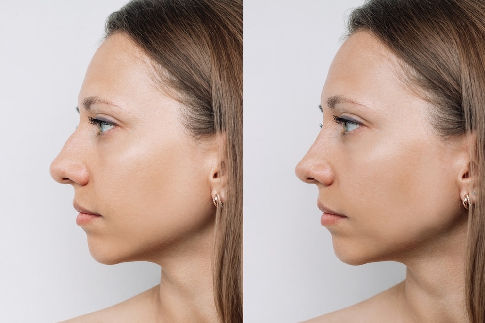 Nose-Surgery-8