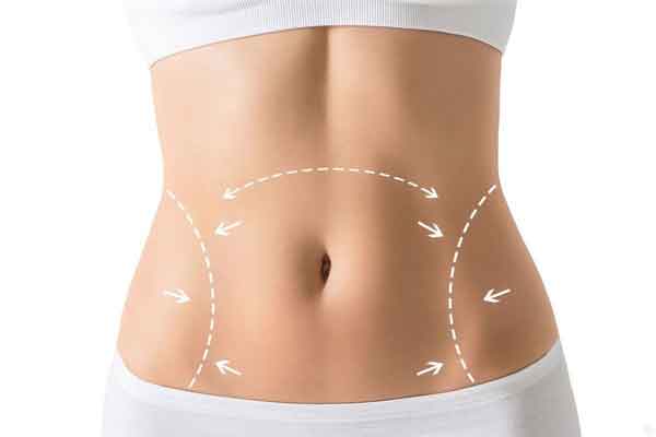 جراحی ابدومینوپلاستی در تهران