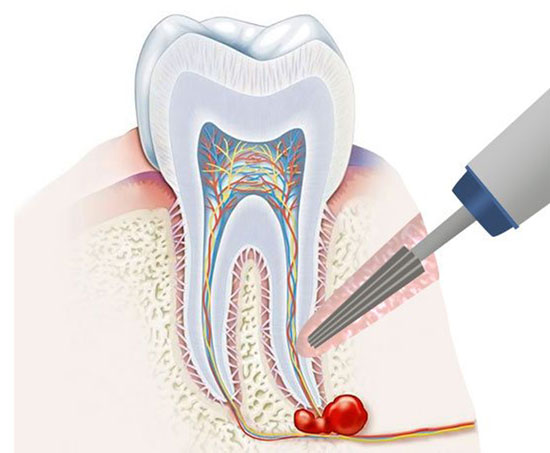 علائم عفونت ریشه دندان چیست؟