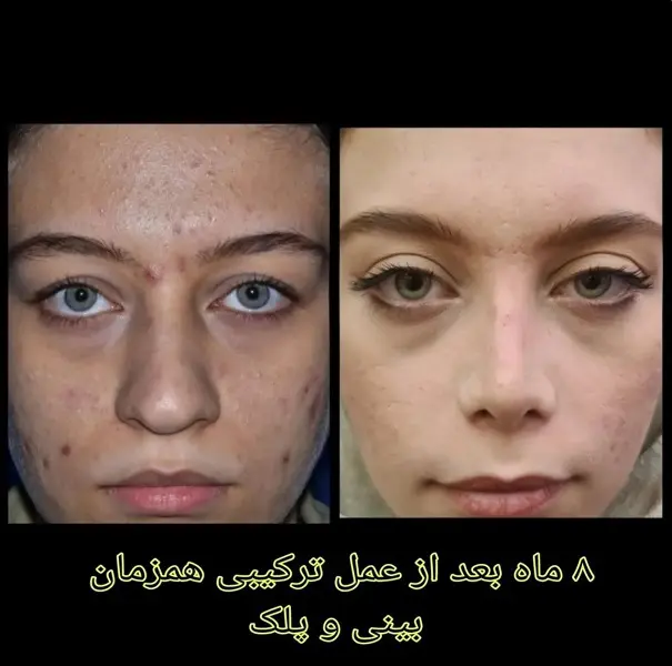 جراحی پلک نمونه های دکتر سعید رجبیان
