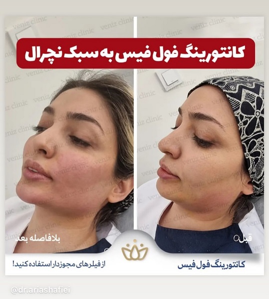 نمونه زاویه سازی صورت دکتر آریا شفیعی