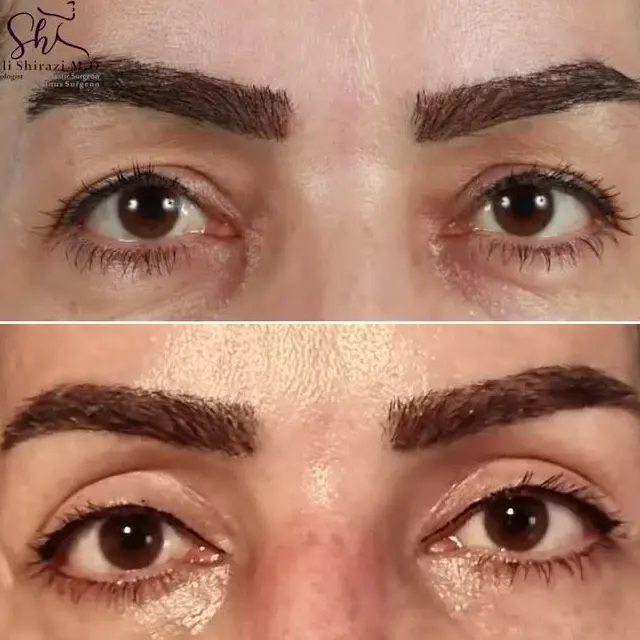 نمونه قبل و بعد از بلفاروپلاستی دکتر علی اصغر شیرازی