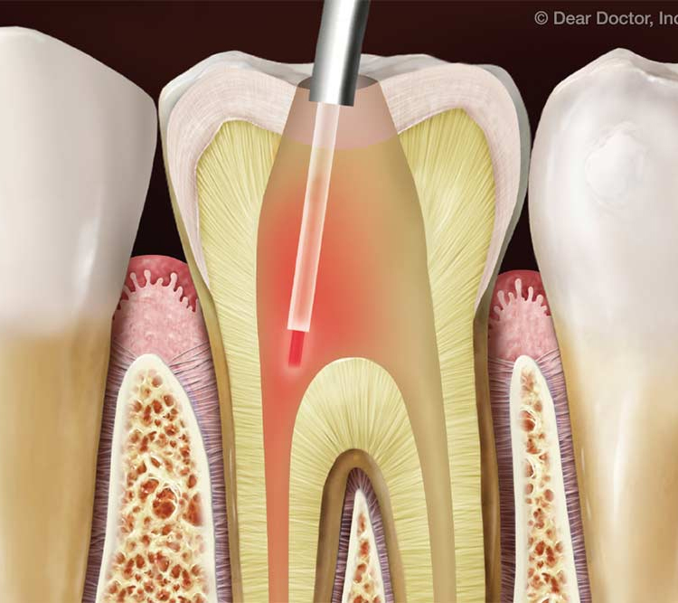 عصب کشی دندان با لیزر
