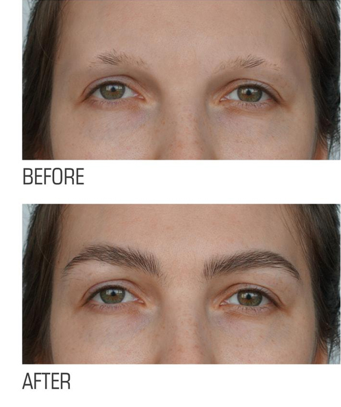 روشهای کاشت ابرو اقساطی در کلینیک لیلیوم سفید