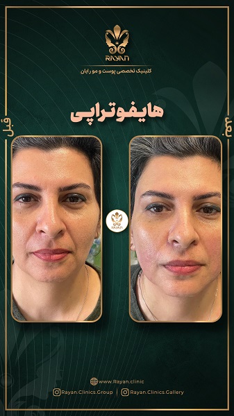 هایفوتراپی صورت - کلینیک رایان سلامت