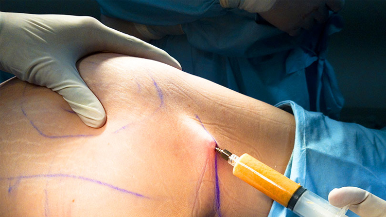 هزینه عمل تزریق چربی به باسن تحت پوشش بیمه قرار میگیرد؟