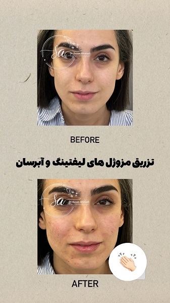 نمونه تزریق مزوژل - دکتر سوسن احمدی