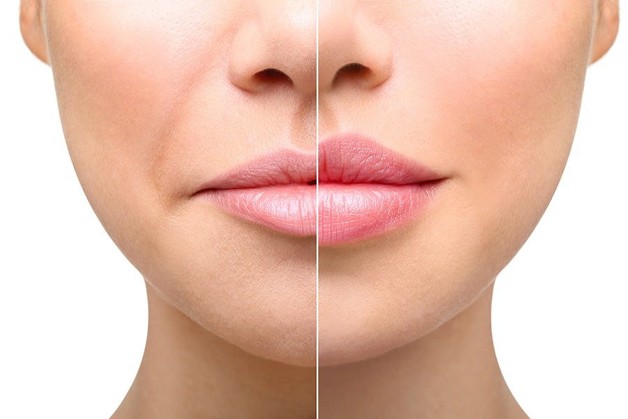 فیلر خط خنده چه مزایا و معایبی دارد؟