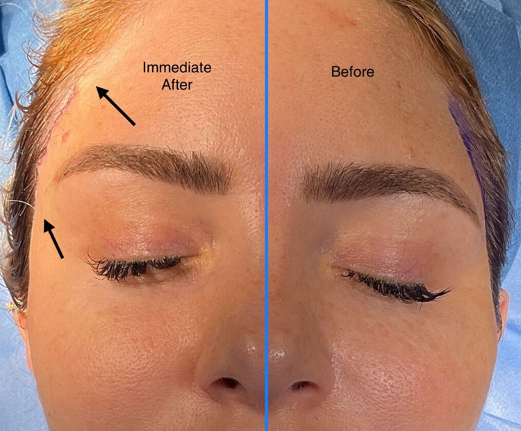 بهترین دکتر لیفت شقیقه چه ویژگیهایی دارد؟