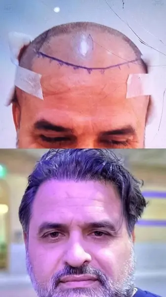 نمونه کاشت مو در کلینیک آرتان