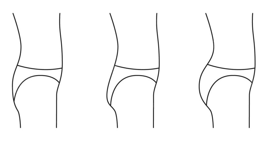 تزریق فیلر به باسن چگونه است؟