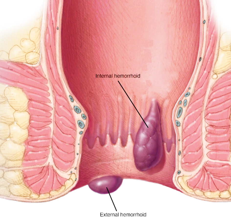 hemorrhoids