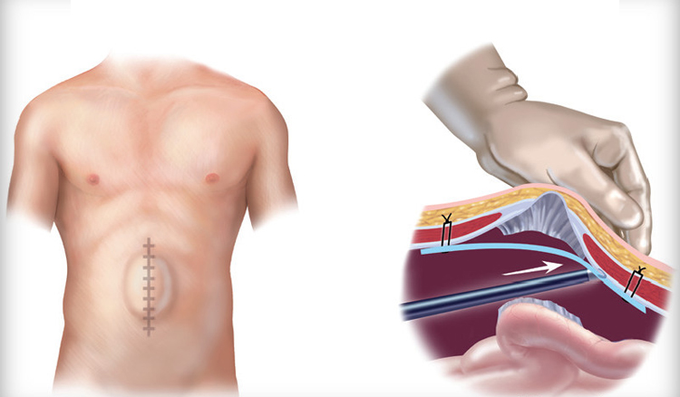 آیا درمان فتق بدون بیهوشی امکان پذیر است؟
