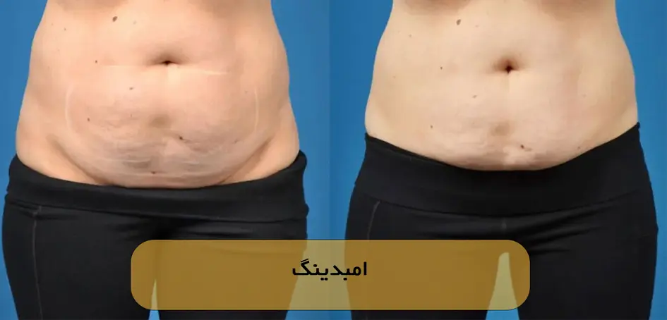 راهنمای کامل امبدینگ (لاغری با نخ) : نحوه انجام، کاربردها، و هزینه