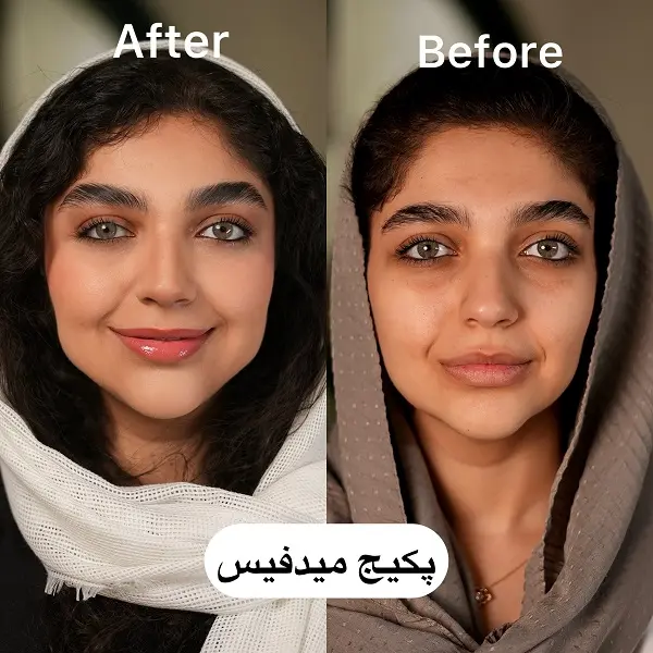 نمونه تزریق ژل گونه در کلینیک آلیما