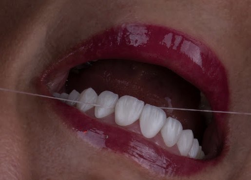 لمینت دندان اقساطی (شرایط پیش پرداخت و قسط)