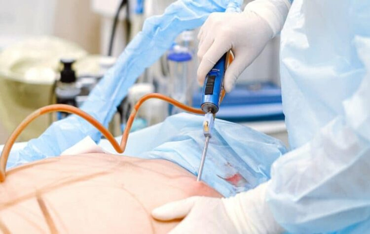 اهمیت مشاوره با بهترین جراح لیپوماتیک در تهران