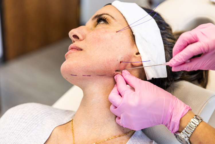 چگونه بهترین پزشک برای لیفت صورت با نخ بیابیم؟