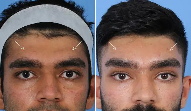 عوارض، خطرات و ریسک های جراحی پیشانی ناندرتال