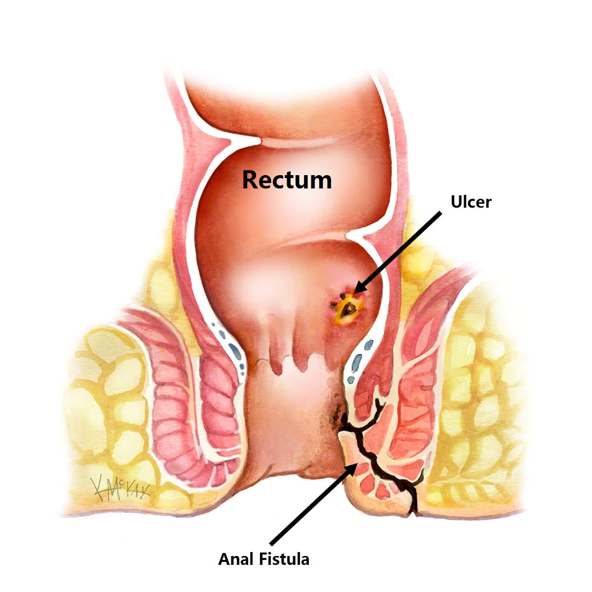 anal-fistula