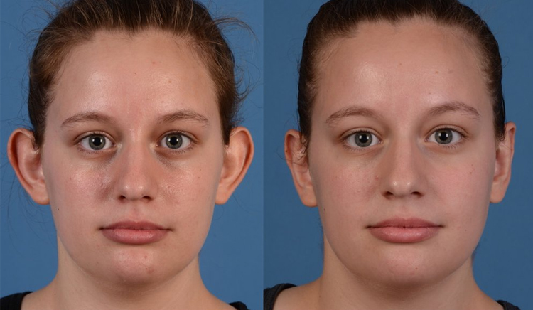 جراحی زیبایی گوش