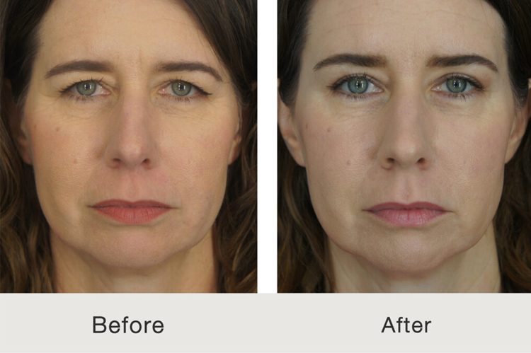 چه افرادی نمی‌توانند از عمل جراحی آندوسکوپی ابرو استفاده کنند؟