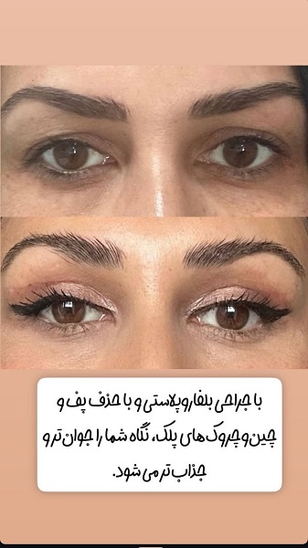نمونه های قبل و بعد از بلفاروپلاستی - سام بیوتی سنتر