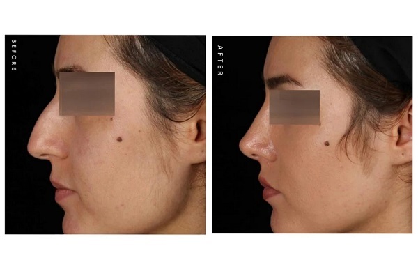 نمونه جراحی بینی استخوانی - کلینیک پارتا