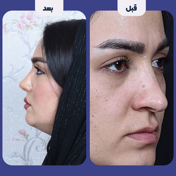 نمونه جراحی بینی دکتر محمد لاجوردی