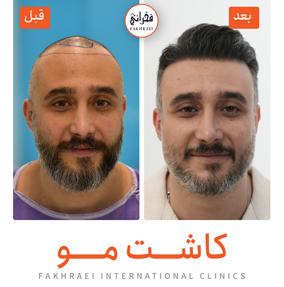 نمونه کاشت مو - کلینیک فخرایی