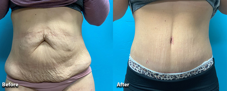 ابدومینوپلاستی