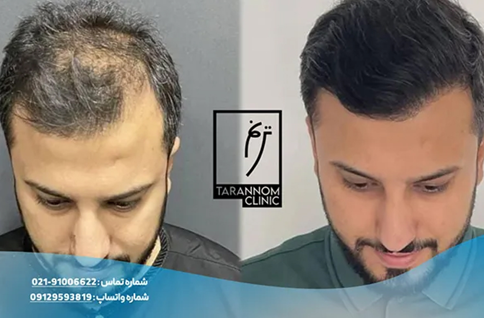 هزینه کاشت مو