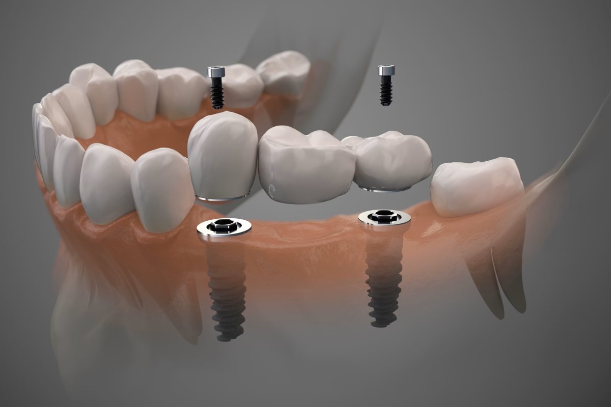 digital-dental-implants