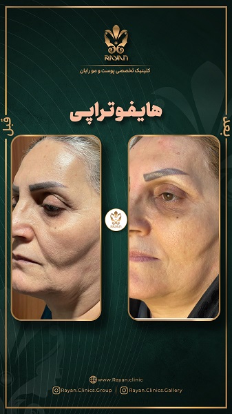هایفوتراپی صورت - کلینیک رایان سلامت