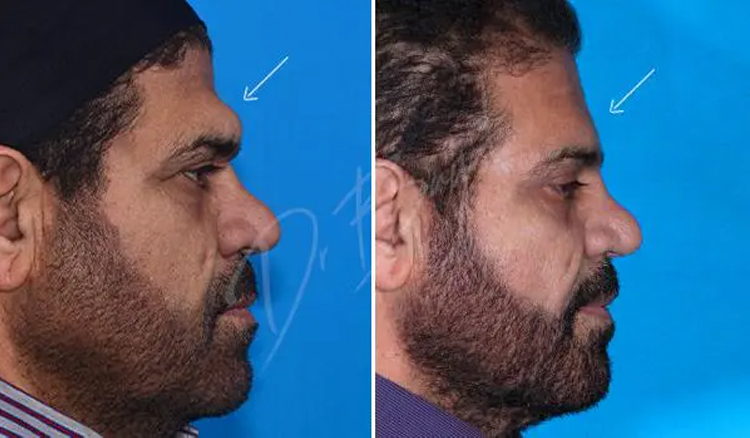 چه کسانی کاندیدای عمل جراحی پیشانی ناندرتال هستند؟