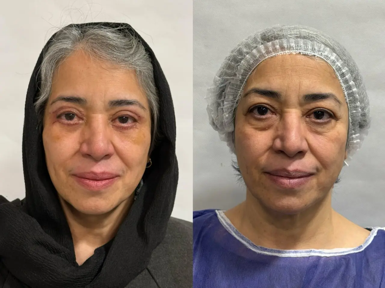 بلفاروپلاستی (1)