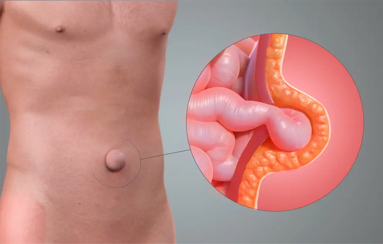 آیا می‌توان فتق را بدون بیهوشی درمان کرد؟ بررسی راهکارهای موجود