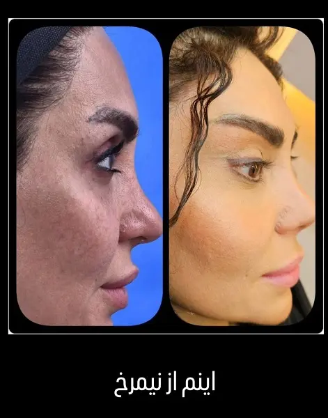 لیفت شقیقه دکتر سعید رجبیان