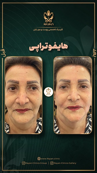 هایفوتراپی صورت - کلینیک رایان سلامت