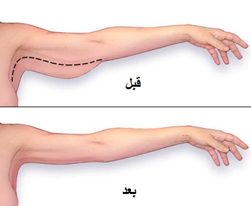 لیفت-بازو-بدون-جراحی