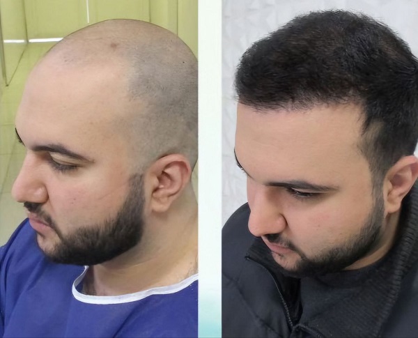 نمونه کاشت مو - کلینیک فرح