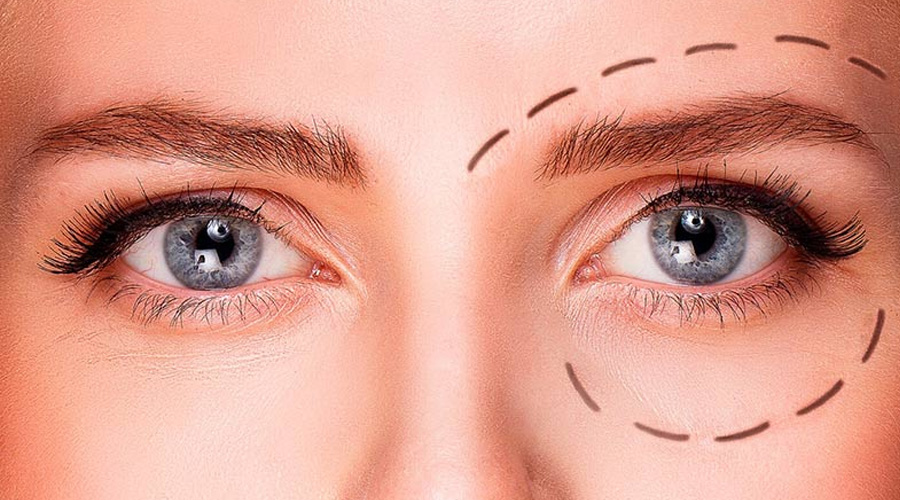 درمان افتادگی پلک با لیزر