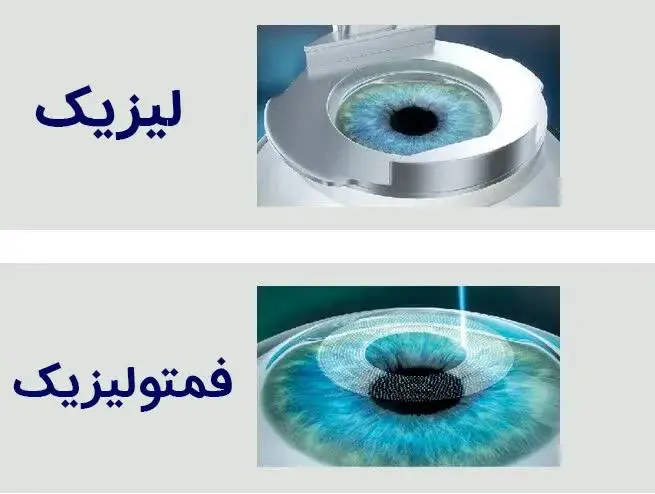 Femto-Lasik-Lasik
