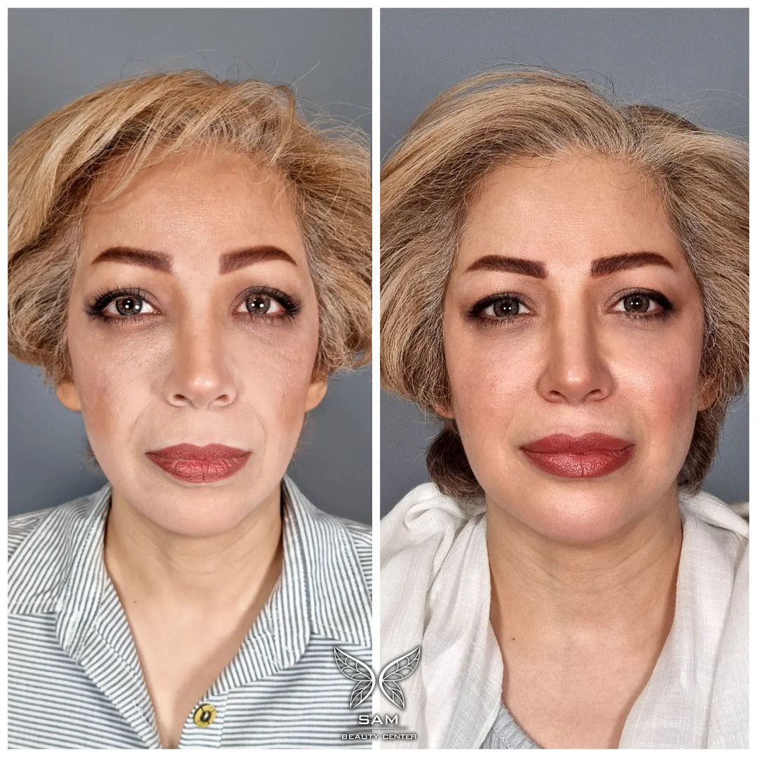 نمونه-عکس-فیلر-خط-خنده-و-گونه1