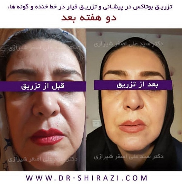 نمونه بوتاکس دکتر علی اصغر شیرازی