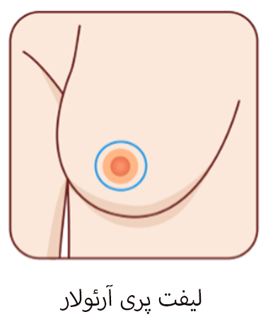 لیفت پری آرئولار