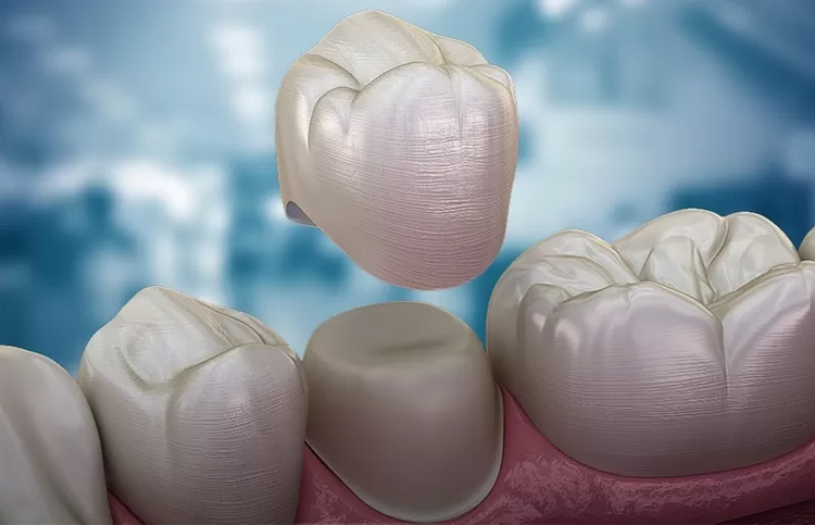 کاربردهای روکش دندان