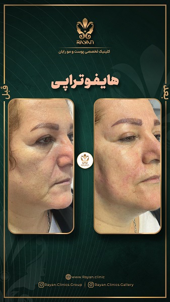 هایفوتراپی صورت - کلینیک رایان سلامت