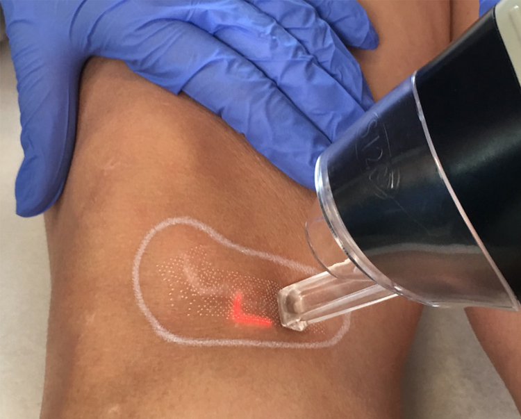 درمان جای زخم با لیزر چیست؟