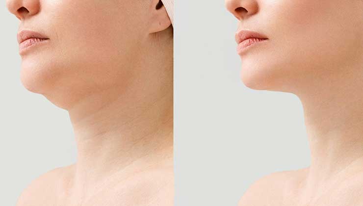 Endolift-for-double-chin-2
